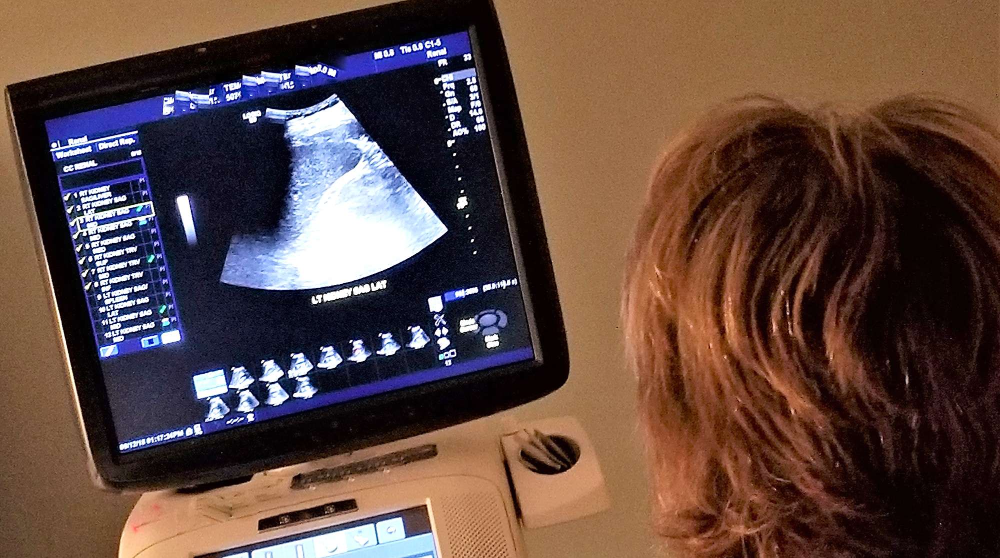 Woman viewing Kidney ultrasound