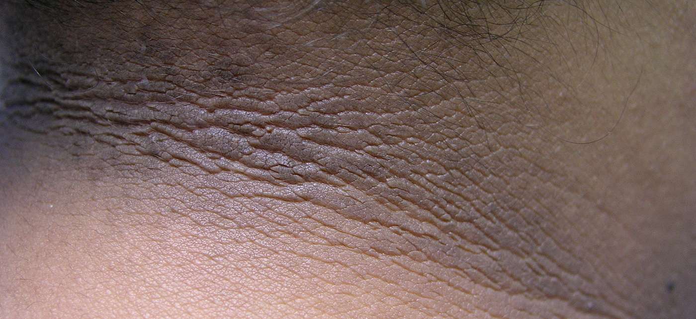 Diabetes Symptoms - Acanthosis Nigrican